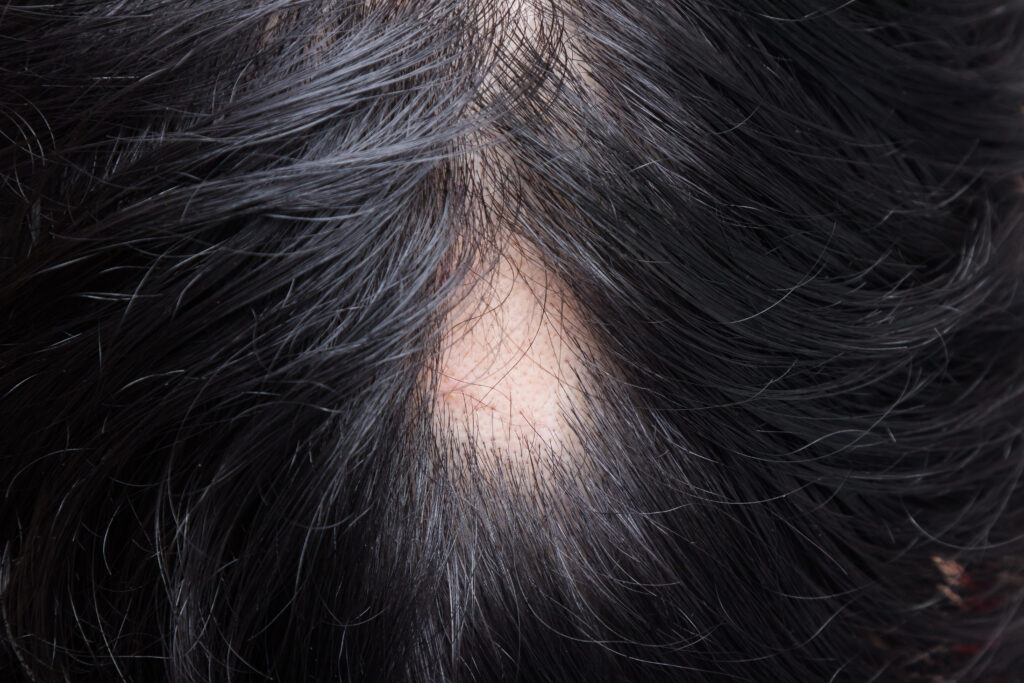 Symptoms and Diagnosis - National Alopecia Areata Foundation | NAAF