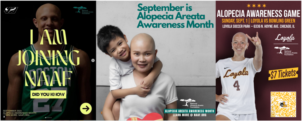 September is Alopecia Areata Awareness Month